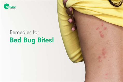 How to Treat Bed Bug Bites .